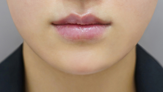 after filler treatment for thin lips
