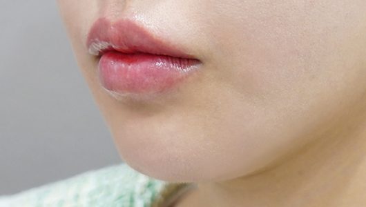 after filler treatment for downturned lips
