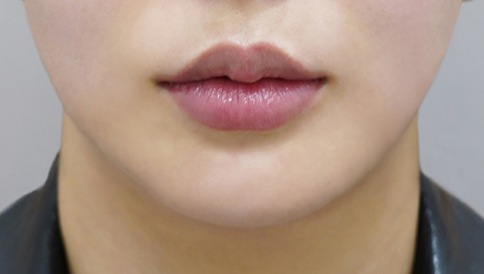 after filler treatment for uneven lips