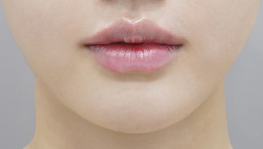 after filler treatment for small lips