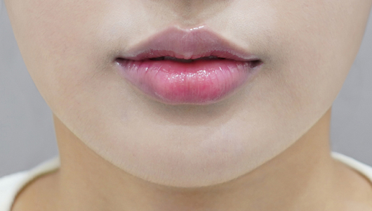 after filler treatment for curled-in lips