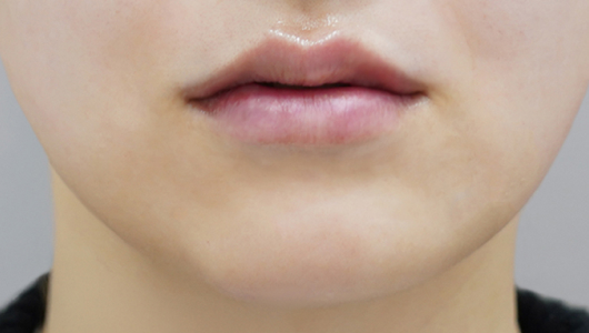 after filler treatment for a long philtrum