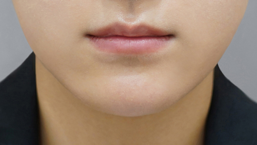 before filler treatment for thin lips