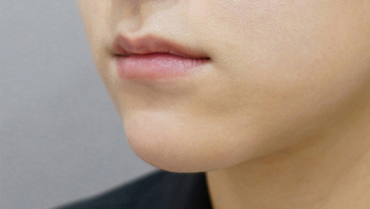 before filler treatment for thin lips
