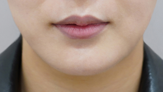 before filler treatment for uneven lips