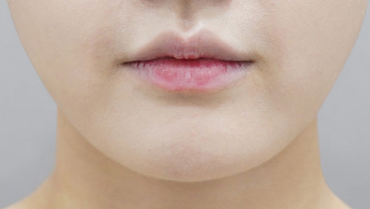 before filler treatment for small lips