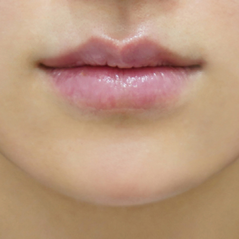 after filler treatment for thin lips