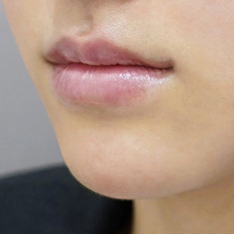 after filler treatment for thin lips