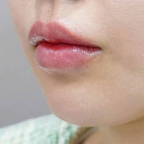 after filler treatment for downturned lips