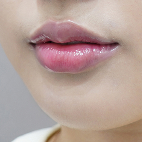 after filler treatment for curled-in lips