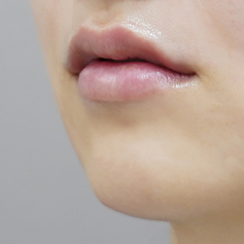 after filler treatment for a long philtrum
