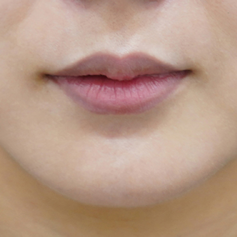 before filler treatment for uneven lips