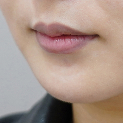 before filler treatment for uneven lips