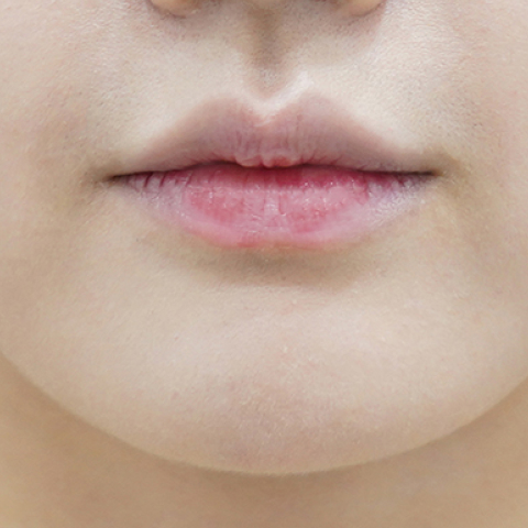 before filler treatment for small lips