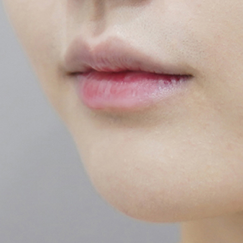 before filler treatment for small lips