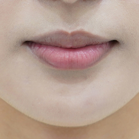 before filler treatment for curled-in lips