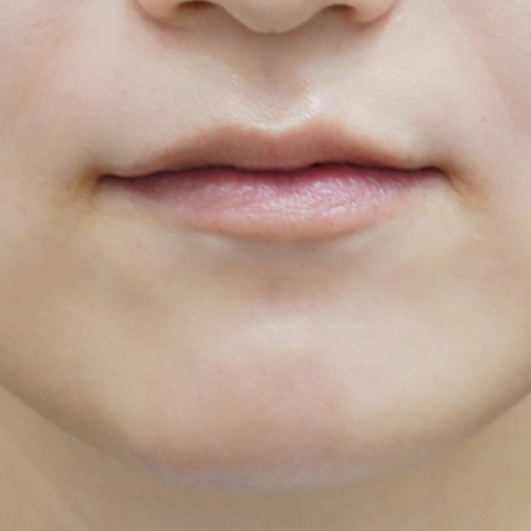 before filler treatment for a long philtrum